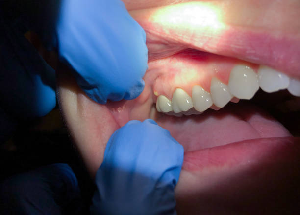 Best Emergency Dental Care for Abscessed Tooth in Enochville, NC