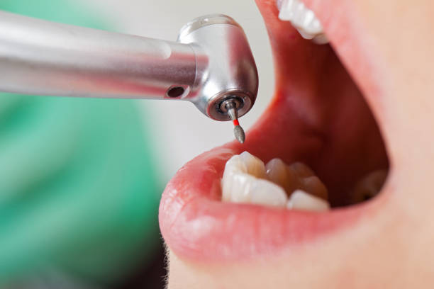 Best Emergency Root Canal Treatment in Enochville, NC